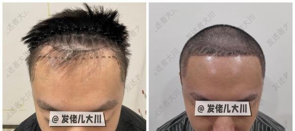 我做发际线种植1500个毛囊，术后两年效果图及真实植发经历分享！植发际线的四大误区及避雷点，一文说清