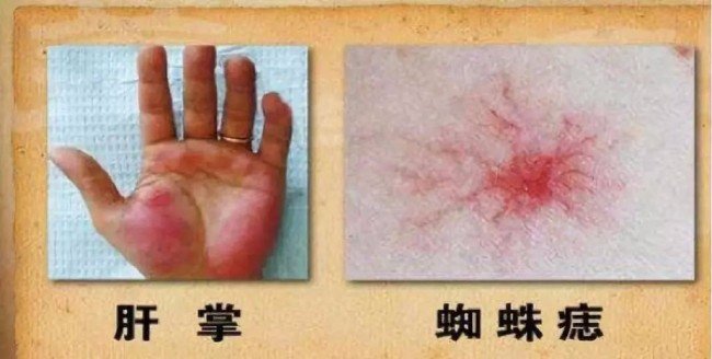 浙江杭州男子相亲被女方父亲发现有肝病,相亲还会继续吗?