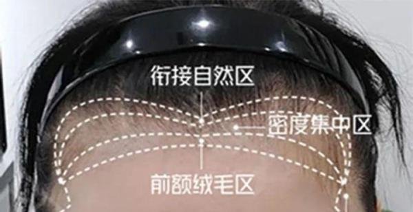 我做发际线种植1500个毛囊,术后两年效果图及真实植发经历分享!植发际线的四大误区及避雷点,一文说清