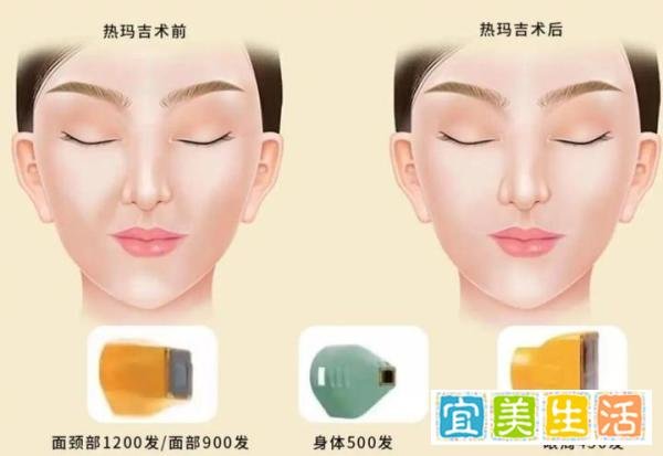 热玛吉多少钱?热玛吉一次多少钱?热玛吉全脸一次多少钱?连问三遍!