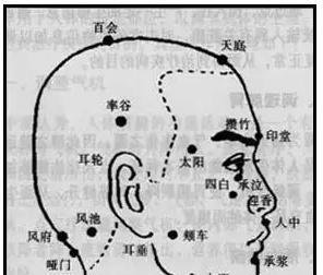 我做发际线种植1500个毛囊,术后两年效果图及真实植发经历分享!植发际线的四大误区及避雷点,一文说清