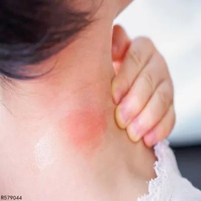 孩子被蚊子咬了肿很大怎么办