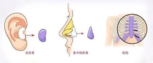 隆鼻的方法都有哪些呢？