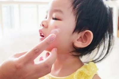 让蚊子咬了怎么止痒消肿