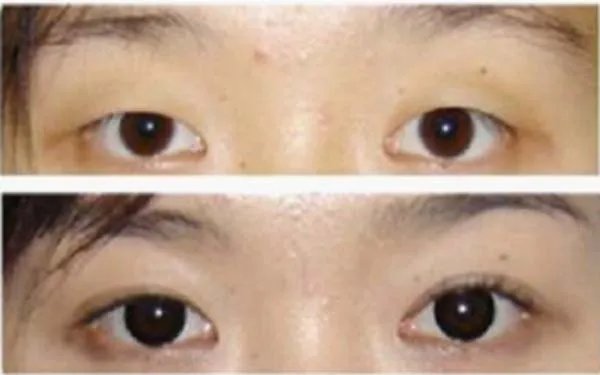 北京哪家医院割双眼皮好?