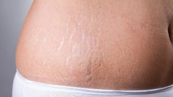 如何去治疗妊娠纹