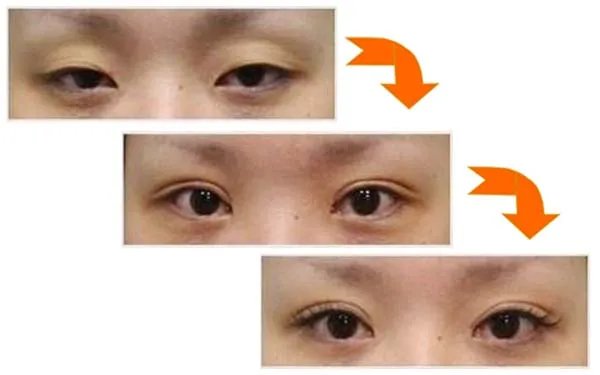 北京双眼皮医院哪里比较好？