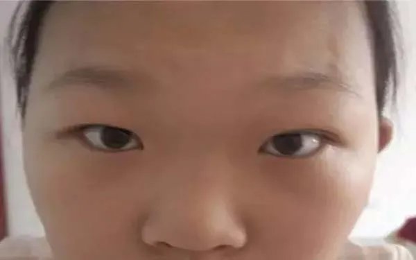 北京双眼皮医院哪里比较好？