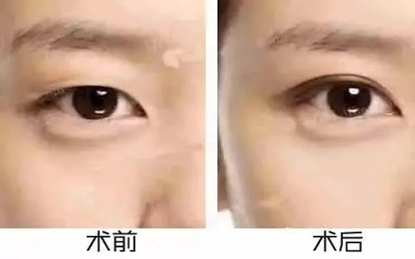 北京哪家医院割双眼皮好?