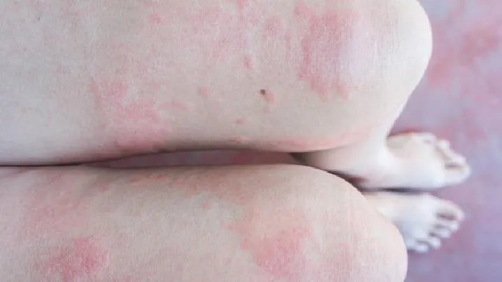 治疗红斑狼疮医院如何选择