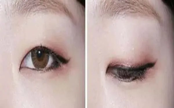 北京双眼皮医院哪里比较好？