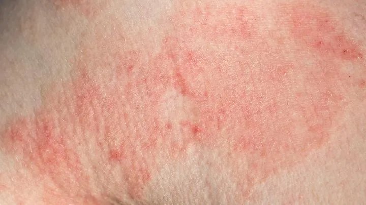 治疗红斑狼疮医院如何选择