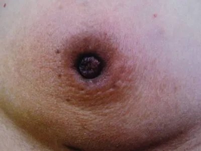 乳腺癌变形图片