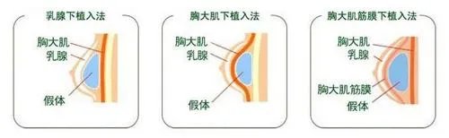 假体隆胸优势在哪里？