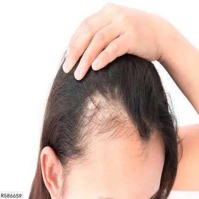 斑秃用什么方法可以治