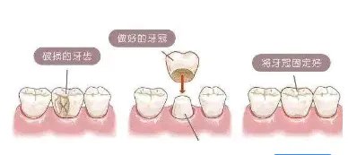 美容冠是什么?