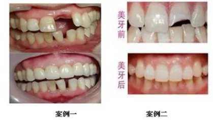 美容冠是什么?