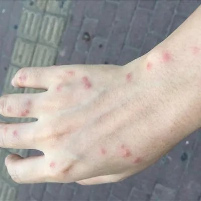 初生婴儿湿疹如何处理?