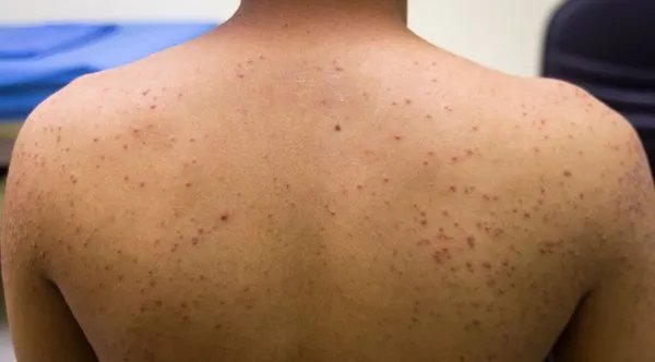 身体里面的毒素是怎么造成的