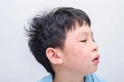 流行性腮腺炎是什么原因