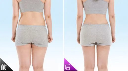 吸脂减肥后遗症吸脂减肥手术真实案例
