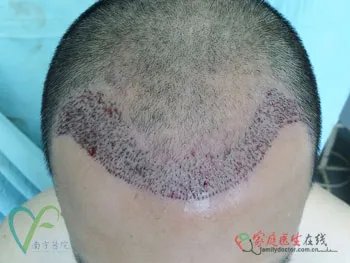 整形案例：揭秘毛发种植全过程