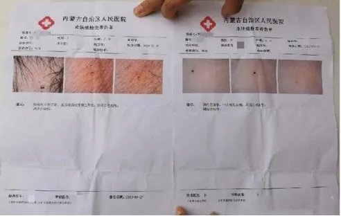 呼和浩特“多名幼儿身上现针眼”案件的最新进展如何?