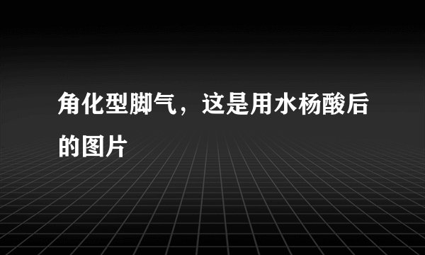 角化型脚气，这是用水杨酸后的图片