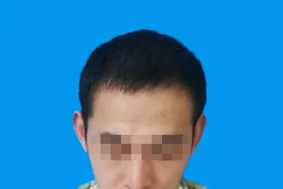 植发3000个单位效果图片