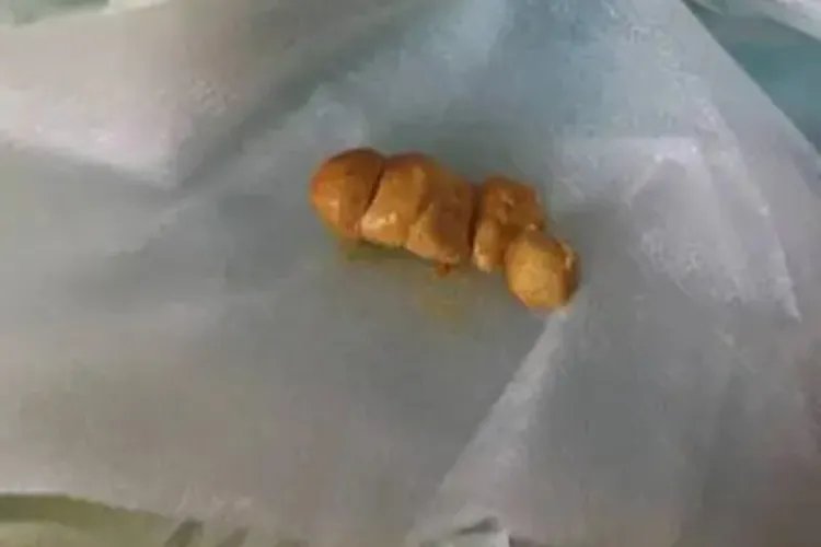 肛裂图片大全