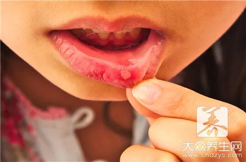 脓疱疮多久能好