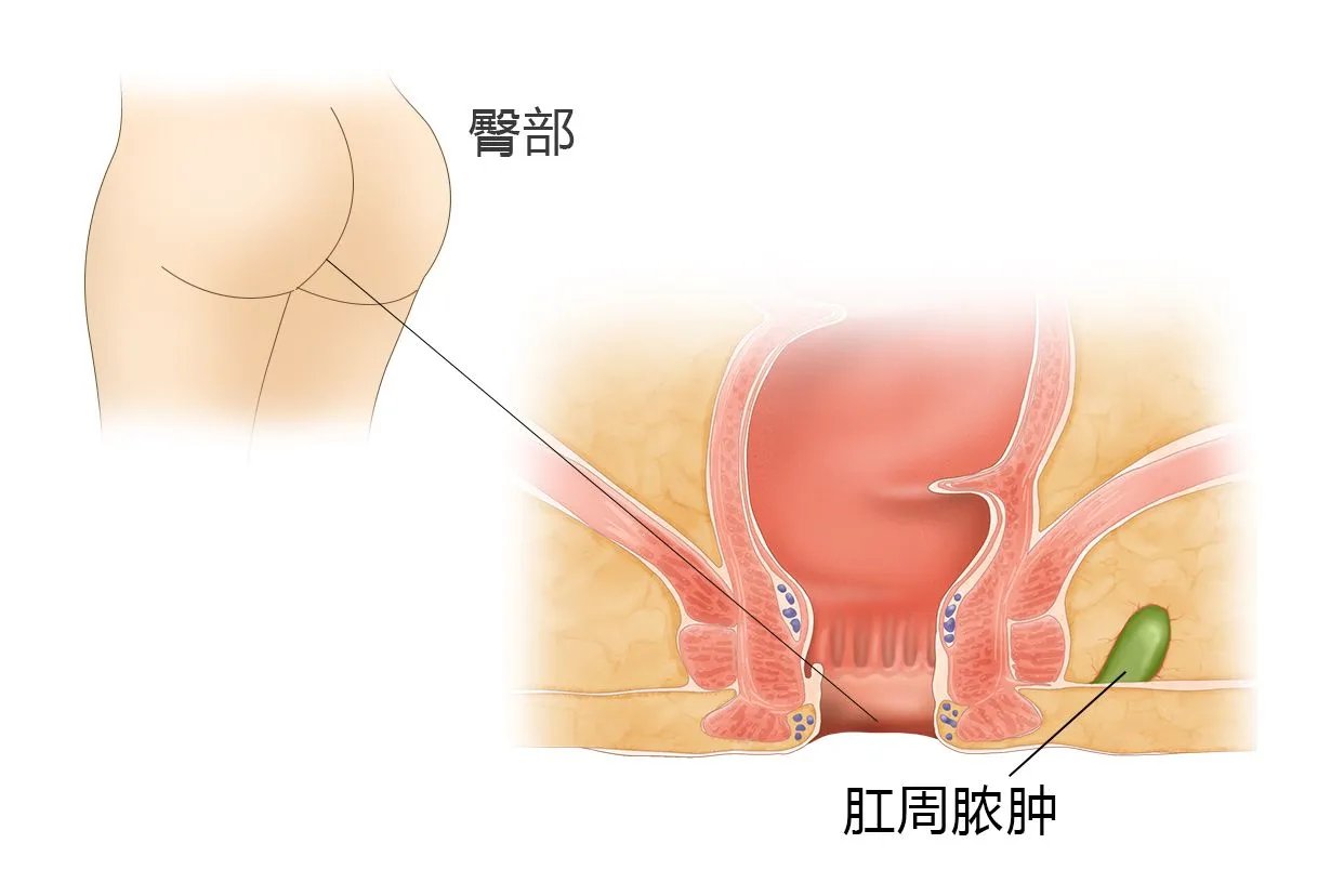 自己怎么判断肛周脓肿图片