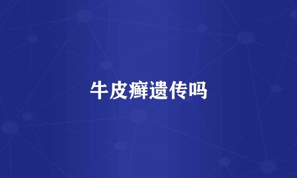 牛皮癣遗传吗