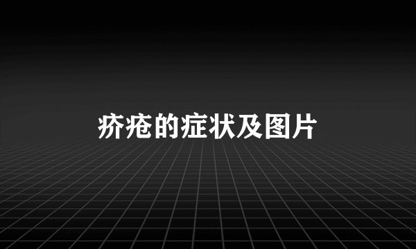 疥疮的症状及图片