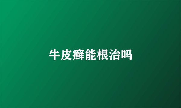 牛皮癣能根治吗