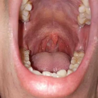 疱疹性咽颊炎怎么治疗?