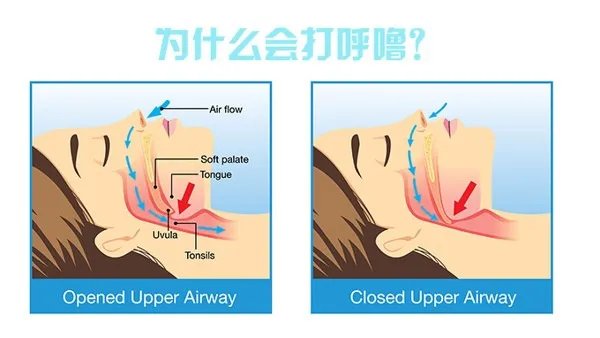气管炎的治疗方法