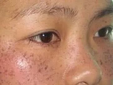 黄褐斑图片是什么样的?