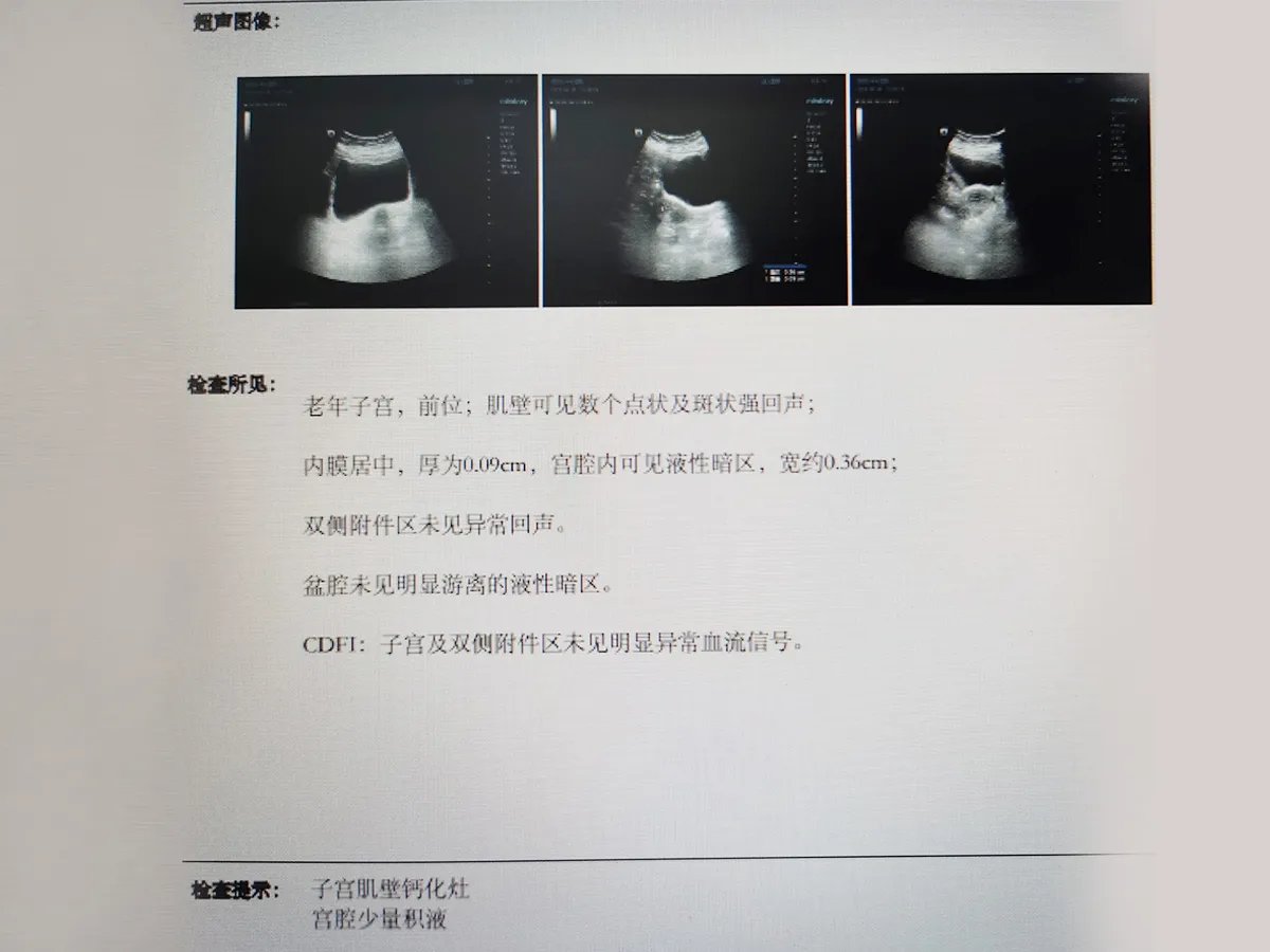 李阿姨患阴道前壁膨出、子宫脱垂,阴道口脱出物是信号