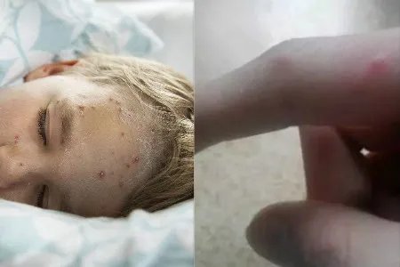 水痘初期症状图片展示