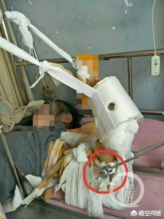 重庆一女童在幼儿园摔骨折，家长怀疑是老师报复，你怎么看？