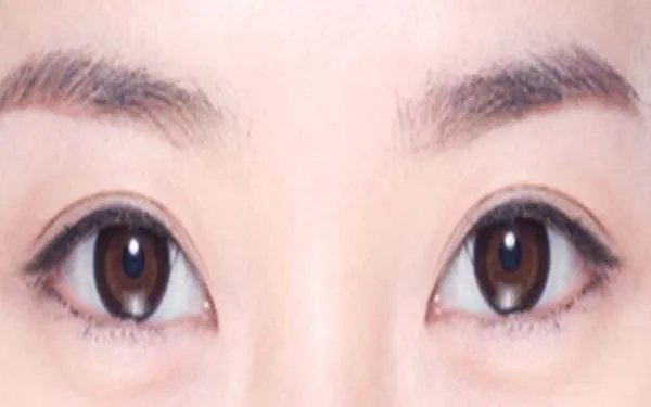 做去眼袋手术好吗