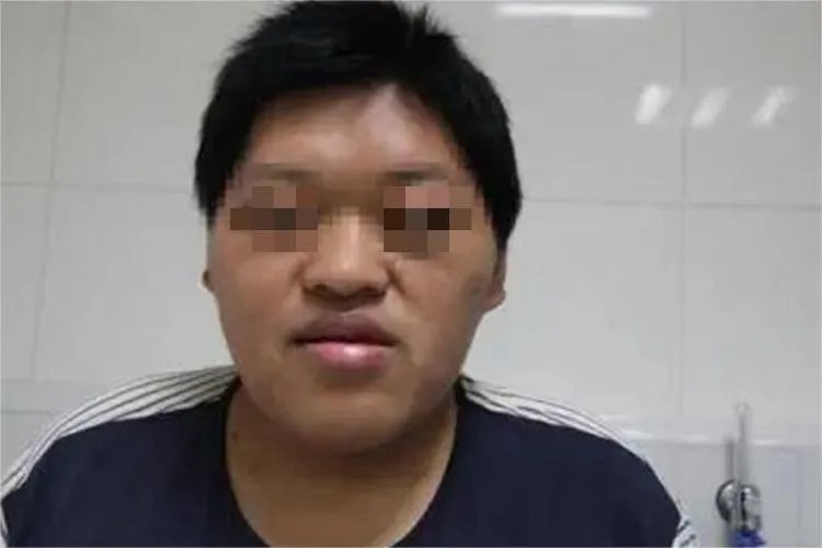 肢端肥大症面部症状图片