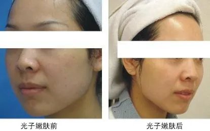 光子嫩肤做一次多少钱