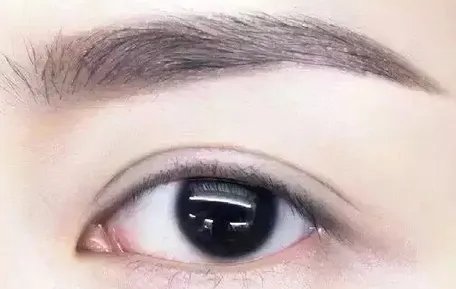韩式埋线双眼皮手术的费用