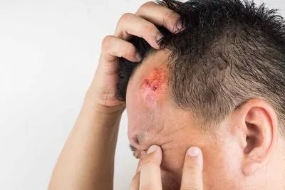 头磕破了怎么处理 头磕破了的急救处理方法揭晓