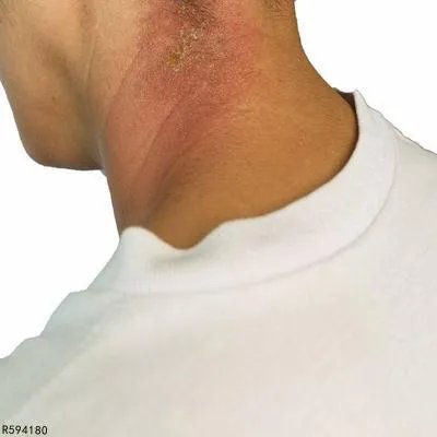 秋季荨麻疹是什么原因引起的