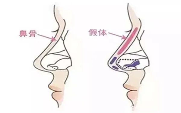 假体隆鼻术需要多少钱