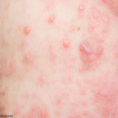 固定性药疹的治疗原则有哪些  需针对病因治疗固定性药疹