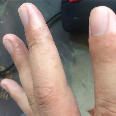汗疱疹是什么原因引起的?